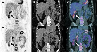 Imaging assessment of toxicity related to immune checkpoint inhibitors
